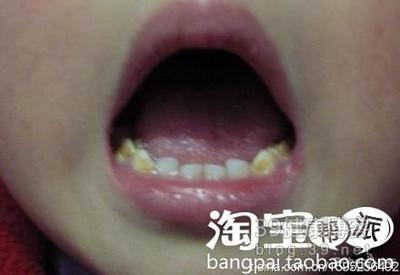 宝宝的牙釉质发育不全，出现了脱落情况 牙釉质发育不全治疗