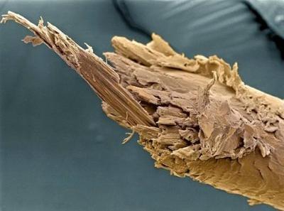 显微镜下一组人类细胞的图片（包括吸烟者的肺癌细胞） 显微镜下的癌细胞