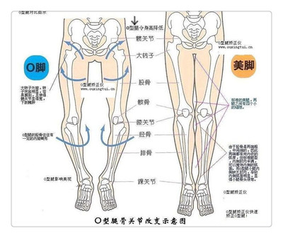 如何矫正O型腿？4种O型腿矫正方法 矫正o型腿的方法