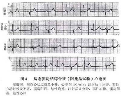 病态窦房结综合征 病态窦房结综合征特点