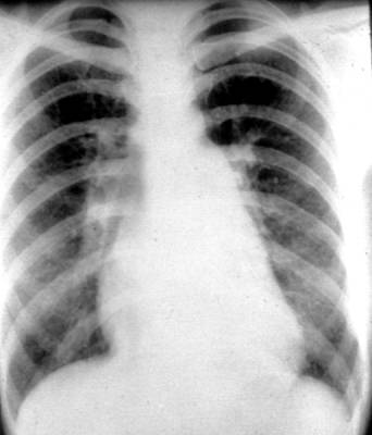 负压性肺水肿 宫腔镜导致肺水肿