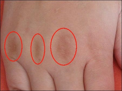 手指第二指关节为什么变粗？ 手指指关节发黑