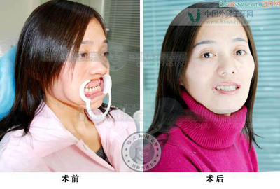 广州牙齿矫正价格表 牙齿矫正的危害