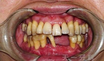 重度牙周炎的治疗——典型病例之一 重度牙周炎如何治疗
