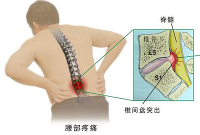 是否你会想知道腰椎间盘突出到底能不能治好呢？ 腰椎间盘突出如何治