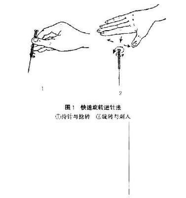 “飞针”进针法 舒张进针法