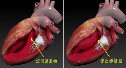 肥厚型梗阻性心肌病临床诊断治疗 肥厚梗阻型心肌病图片