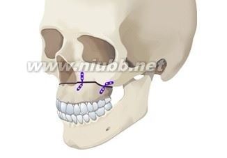 双颚手术-（上颚手术方法） 上颚骨突出手术