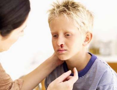 幼儿鼻出血的处理方法 小孩流鼻血会是白血病