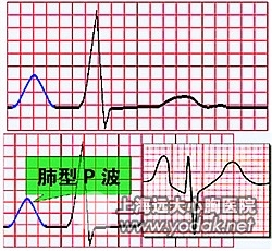 肺型P波 肺型p波心电图严重吗