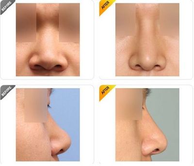 Gunter鼻整形图系统 整形医院管理系统