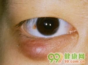 麦粒肿（俗称针眼）的症状及诊治 麦粒肿初期症状