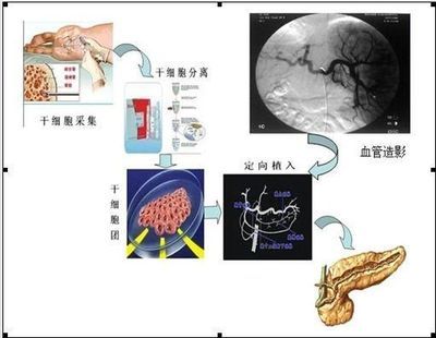 脐带血干细胞移植治疗2型糖尿病一例 干细胞移植治疗糖尿病