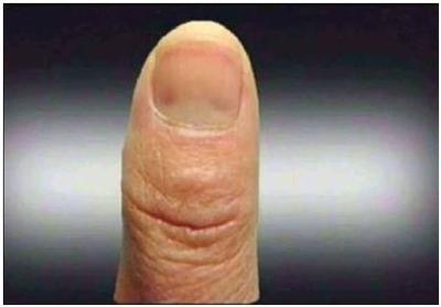 指甲上有竖纹、凹凸是怎么回事？ 指甲上竖纹是怎么回事