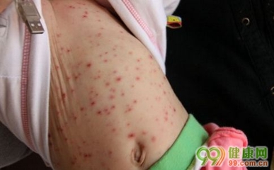 孩子出水痘的症状有哪些 小孩子出水痘的症状