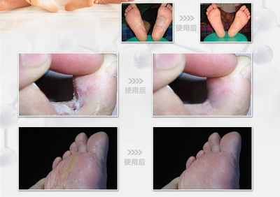 【脚气病大全辑】- 脚气/脚臭/脚汗治疗 脚气病的治疗方法