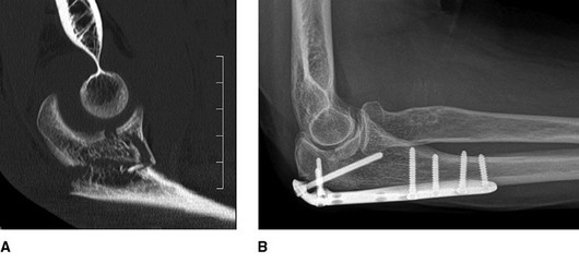 尺骨鹰嘴骨折（1）——概述和分类 尺骨鹰嘴骨折手术入路