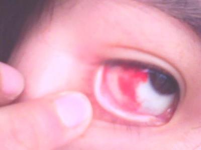 眼睛的白眼球上总是充血，出现小红血块是怎么回事，应该怎么治疗 眼球充血