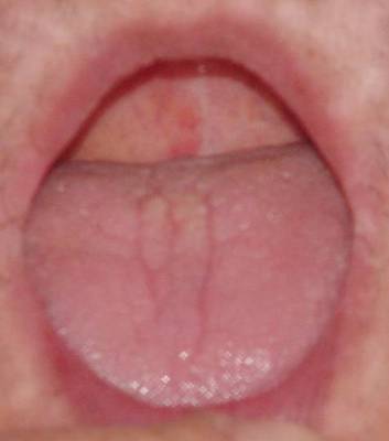 望舌质 舌下络脉 舌脉两边血管紫黑