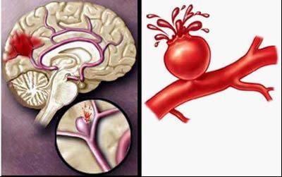 什么是脑卒中 脑卒中是脑出血吗