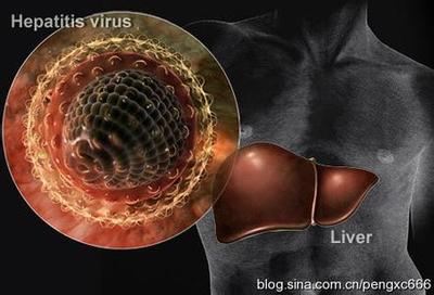 丙型肝炎可治愈 丙型肝炎防治指南