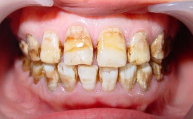 怎样判定氟斑牙和氟骨症 怎样去除氟斑牙