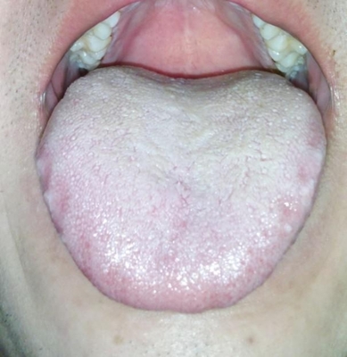 舌苔厚白的原因 舌苔厚白黄是怎么回事