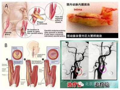 可以治疗颈动脉粥样硬化斑块的中药 双侧颈动脉硬化斑块