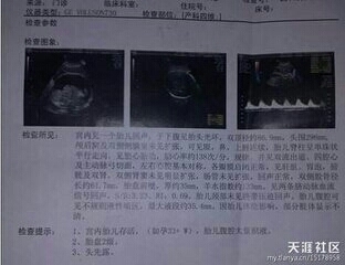 34周 孕35周胎儿入盆图片