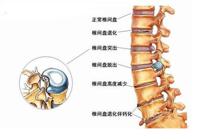 腰椎盘突出怎么治疗 腰椎盘突出怎么治疗好