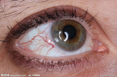 眼睛红血丝原因 眼球有红血丝