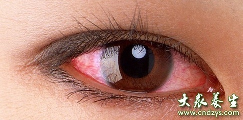 眼睛红血丝是怎么回事？ 眼睛红血丝怎么回事