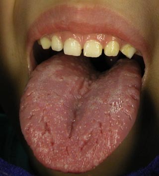 淡白舌的舌象和照片 舌淡胖苔白
