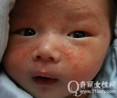 宝宝湿疹是怎么引起的 宝宝湿疹最佳治疗方法