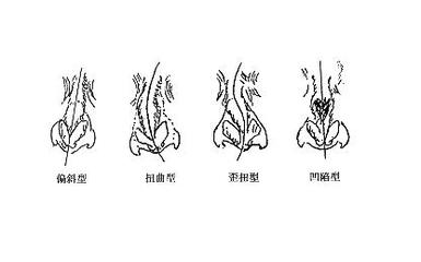 鼻中隔偏曲手术后护理应注意哪些 鼻中隔偏曲手术费用