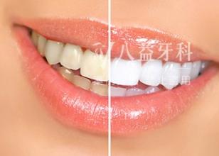  做牙齿美容冠要多少钱 牙齿美容 广州时尚“钱”线
