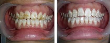  氟斑牙牙齿美白价格 氟斑牙和四环素牙齿的原因
