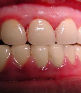 经常牙龈出血是什么原因