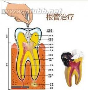 急性牙髓炎 急性牙髓炎-疼痛特点，急性牙髓炎-疾病诊断