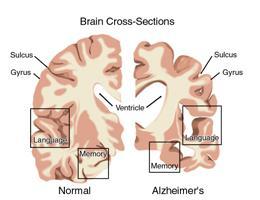 阿尔茨海默病 阿尔茨海默病-概述，阿尔茨海默病-疾病分类