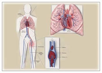 肺栓塞 肺栓塞-概述，肺栓塞-流行病学