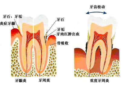 牙龈肿痛 牙龈肿痛-概述成因，牙龈肿痛-临床表现