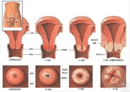 宫颈癌 宫颈癌-概述，宫颈癌-分期