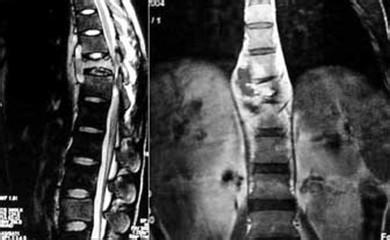 脊柱结核的症状 脊柱结核 脊柱结核-脊柱结核概述，脊柱结核-症状