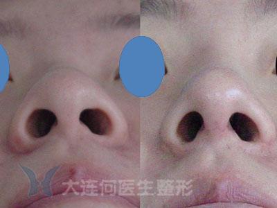 膨体隆鼻手术 膨体隆鼻手术-膨体隆鼻手术概述，膨体隆鼻手术-膨