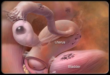子宫内膜异位性不孕 子宫内膜异位性不孕-发病原因，子宫内膜异位