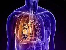 肺腺癌 肺腺癌-疾病分类，肺腺癌-发病原因