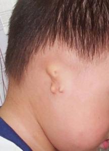 小耳畸形 小耳畸形-临床表现，小耳畸形-诊断鉴别