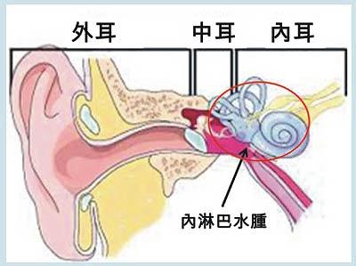 美尼尔氏症 美尼尔氏症-基本概念，美尼尔氏症-症状介绍