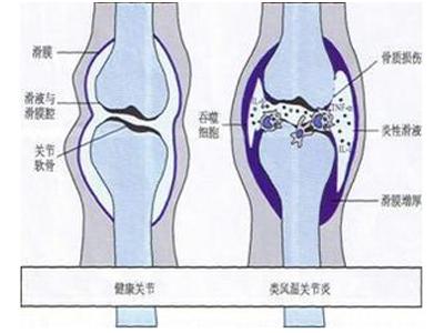 类风湿关节炎 风湿性关节炎和类风湿关节炎的区别